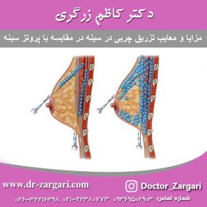 تزریق چربی در سینه