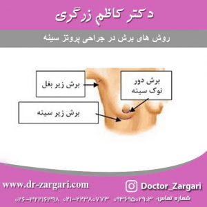 برش در جراحی پروتز سینه