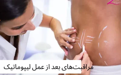 مراقبتها بعد از لیپوماتیک و دوره نقاهت بعد از لیپوماتیک