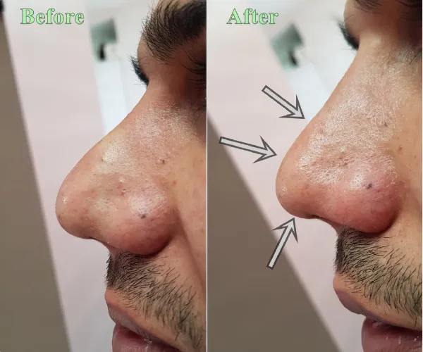 عکس-قبل-بعد-تزریق-کورتون-بینی عکس قبل و بعد تزریق کورتون به بینی