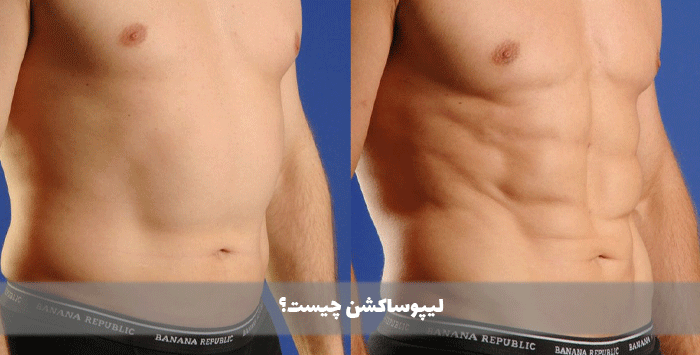 لیپوساکشن چیست؟