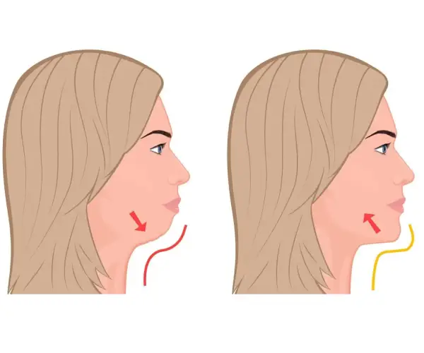 لیپوماتیک غبغب چیست؟ لیپوماتیک غبغب چیست؟