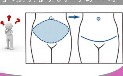 سوالات متداول در خصوص جراحی ابدومینوپلاستی