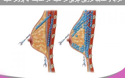 مزایا و معایب تزریق چربی در سینه در مقایسه با پروتز سینه