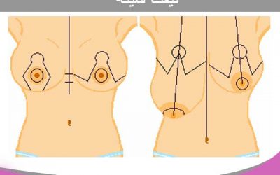 جراحی لیفت سینه