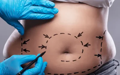 وزن مناسب برای لیپوماتیک