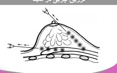 تزریق چربی به سینه یا پستان