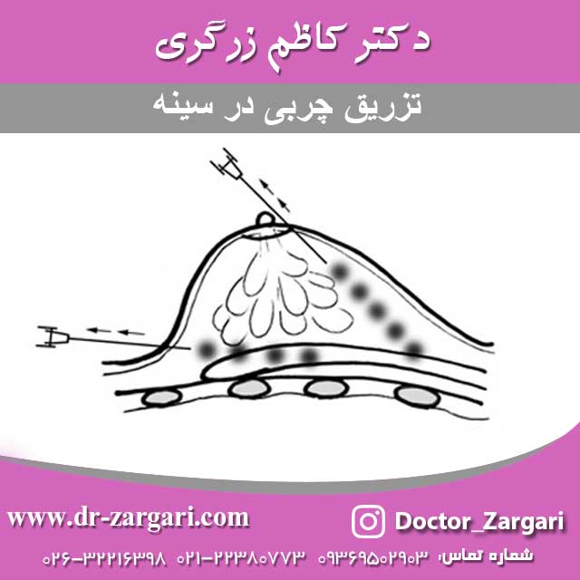 تزریق چربی در سینه