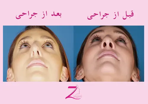 نتیجه جراحی کوچک کردن پره های بینی