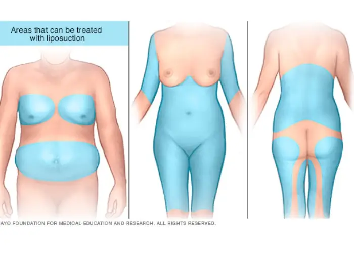 تفاوت-لیپوماتیک-لیپولیز تفاوت لیپوماتیک ولیپولیز