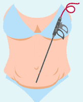 عمل-لیپوماتیک