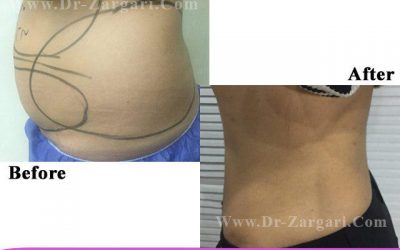 مراحل لیپوماتیک