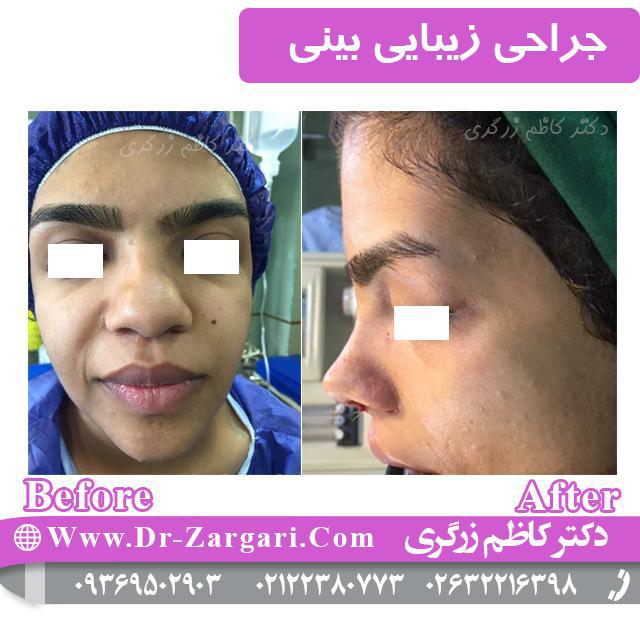 هزینه جراحی بینی