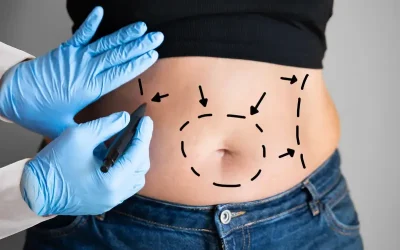 ابدومینوپلاستی چیست؟ مراحل و انواع