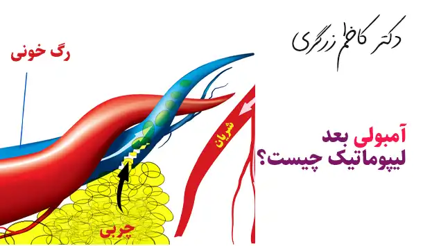 آمبولی بعد لیپوماتیک چیست؟