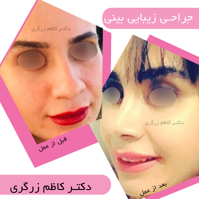 نمونه جراحی زیبایی بینی