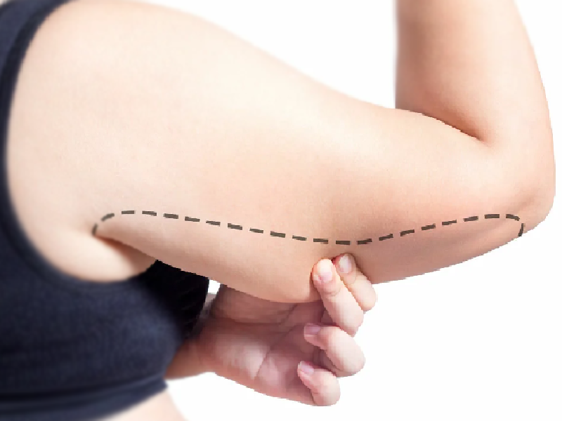 لیپوماتیک بازو