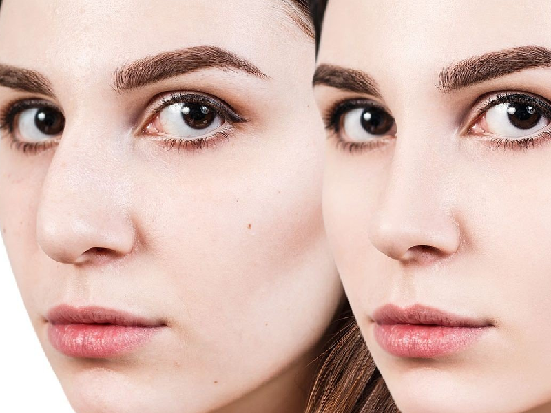 بهترین جراح بینی گوشتی