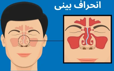 جراحی انحراف بینی چیست؟