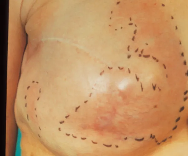 عفونت-بعد-پروتز-سینه عفونت پروتز سینه