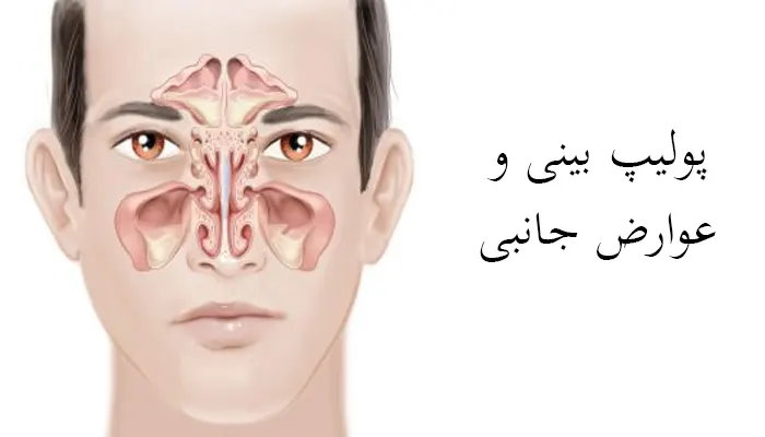 عوارض جانبی پولیپ بینی