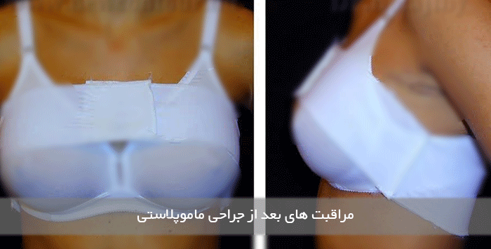 مراقبت های بعد از ماموپلاستی