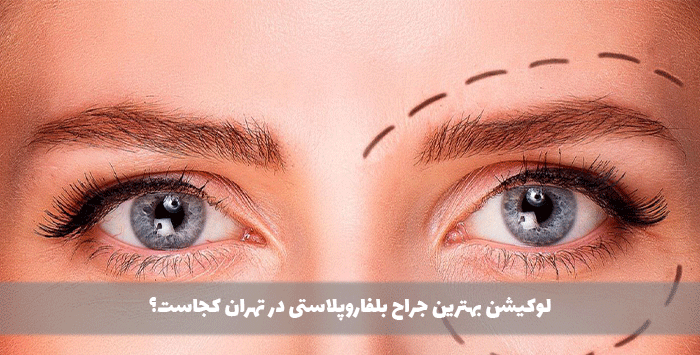لوکیشن بهترین جراح بلفاروپلاستی در تهران کجاست؟