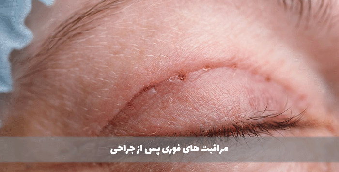 مراقبت های فوری پس از جراحی