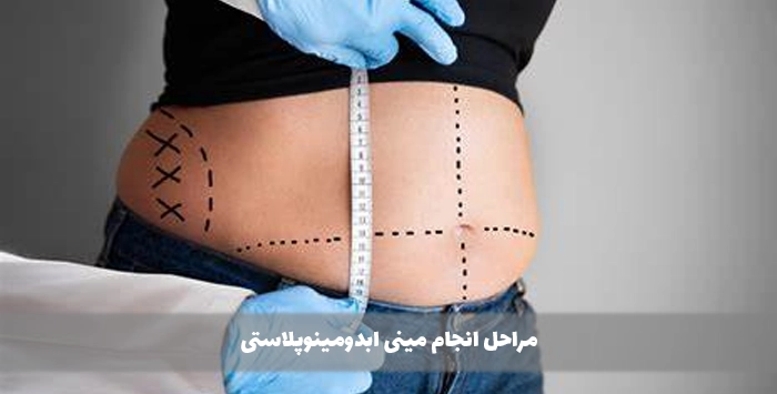 مراحل انجام مینی ابدومینوپلاستی