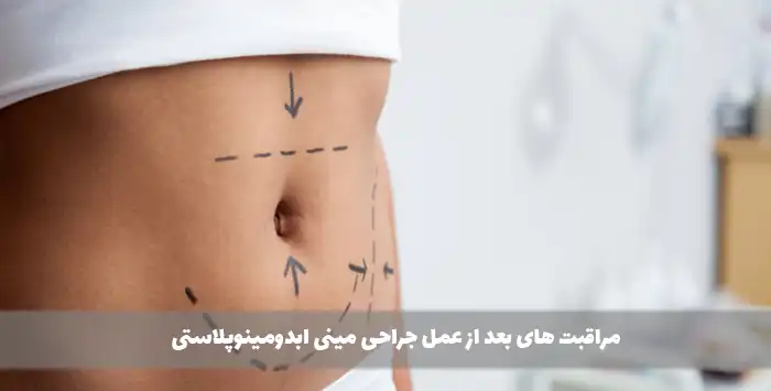 مراقبت های بعد از عمل جراحی مینی ابدومینوپلاستی