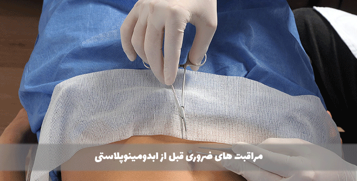 مراقبت های ضروری قبل از ابدومینوپلاستی
