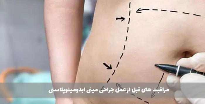 مراقبت های قبل از عمل جراحی مینی ابدومینوپلاستی