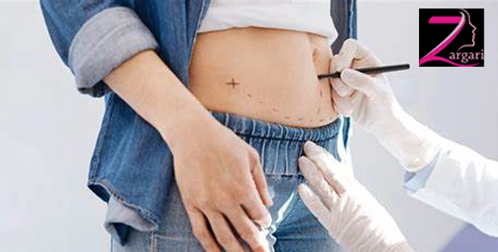 نتایج و فواید مینی ابدومینوپلاستی