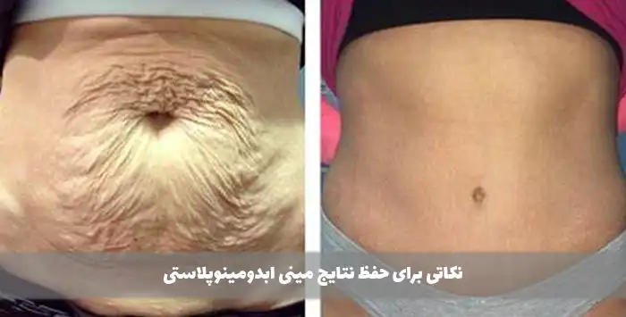 نکاتی برای حفظ نتایج مینی ابدومینوپلاستی