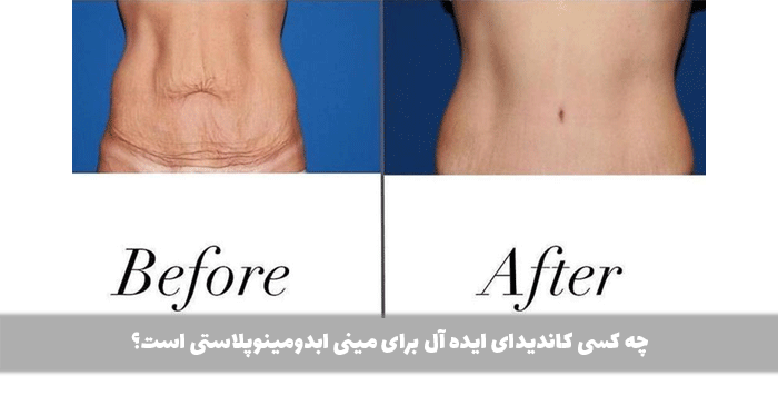 چه کسی کاندیدای ایده آل برای مینی ابدومینوپلاستی است؟