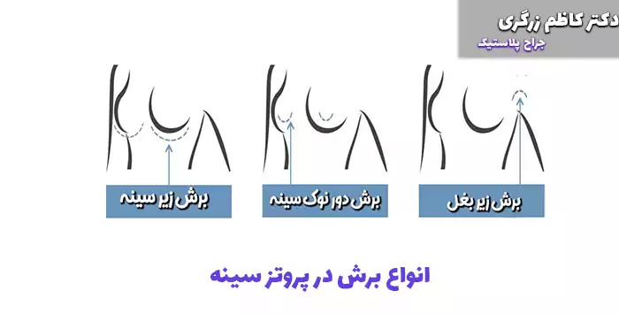 انواع برش در پروتز سینه