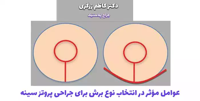 عوامل مؤثر در انتخاب نوع برش برای جراحی پروتز سینه