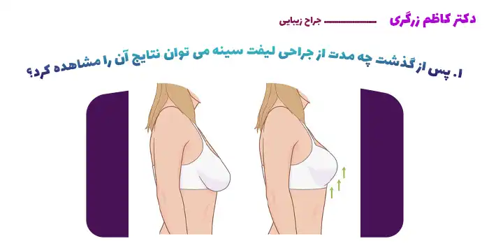 1. پس از گذشت چه مدت از جراحی لیفت سینه می توان نتایج آن را مشاهده کرد؟