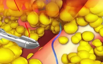 آمبولی بعد از لیپوماتیک چه علتی دارد ؟