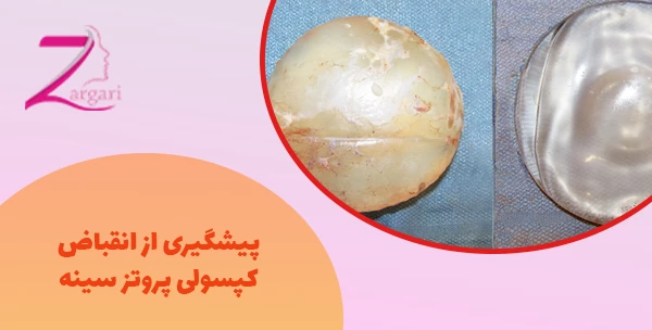 پیشگیری از انقباض کپسولی پروتز سینه