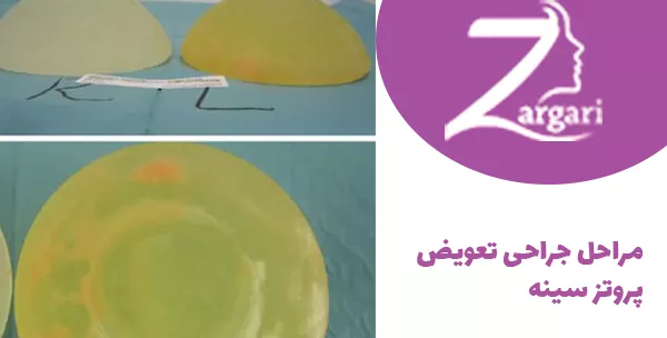 مراحل جراحی تعویض پروتز سینه