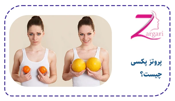 پروتز پکسی چیست؟