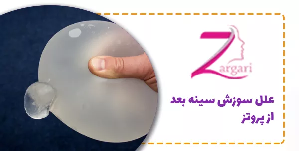 علل سوزش سینه بعد از پروتز