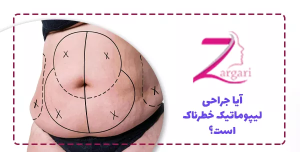 آیا جراحی لیپوماتیک خطرناک است؟