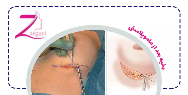 بخیه بعد از ماموپلاستی چیست