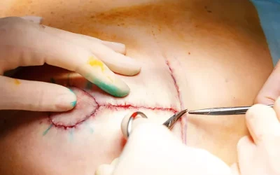 جراحی ماموپلاستی در کرج (انواع، مراحل و مزایا)