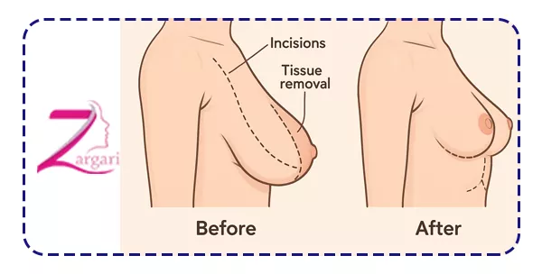 عمل ماموپلاستی چیست؟