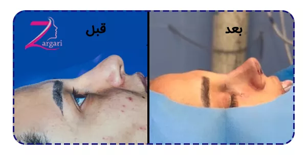 قبل و بعد از جراحی بینی گوشتی