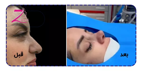 قبل و بعد رینوپلاستی گوشتی