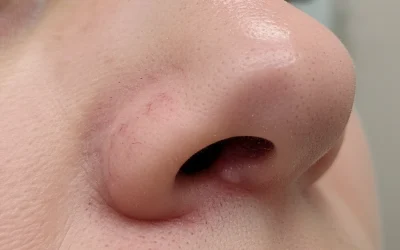 تشکیل گوشت اضافه روی بینی بعد از عمل طبیعی است؟